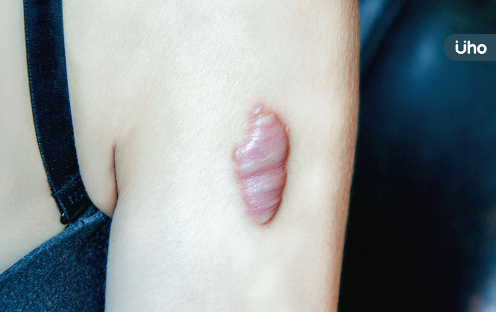傷口疤痕感染「蟹足腫」如背長巨蟲！醫揭好發部位「2招」可預防
