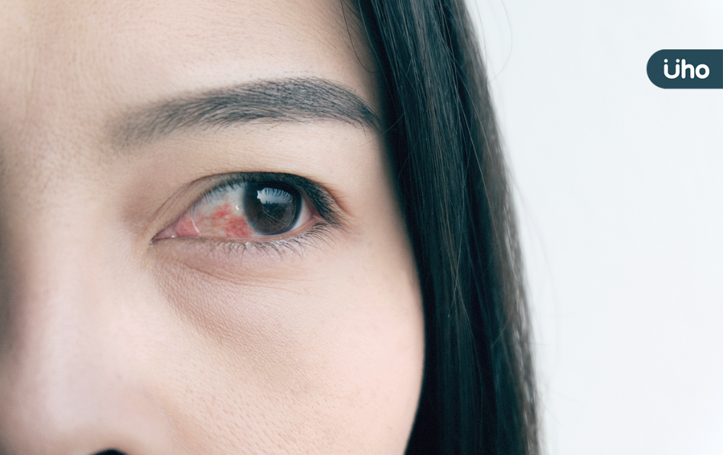 起床後「眼白出血」是眼中風前兆嗎？醫揭真實原因竟跟「便秘」有關