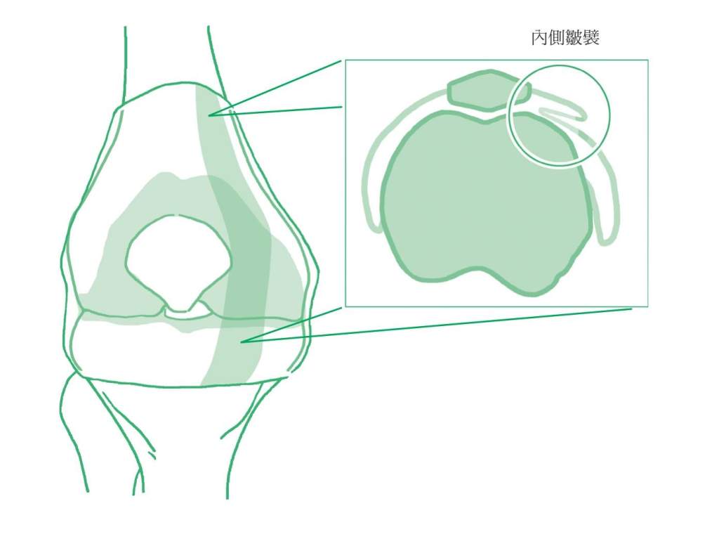 膝蓋痛不是退化！骨科名醫：「內側摩擦現象」是關鍵元凶