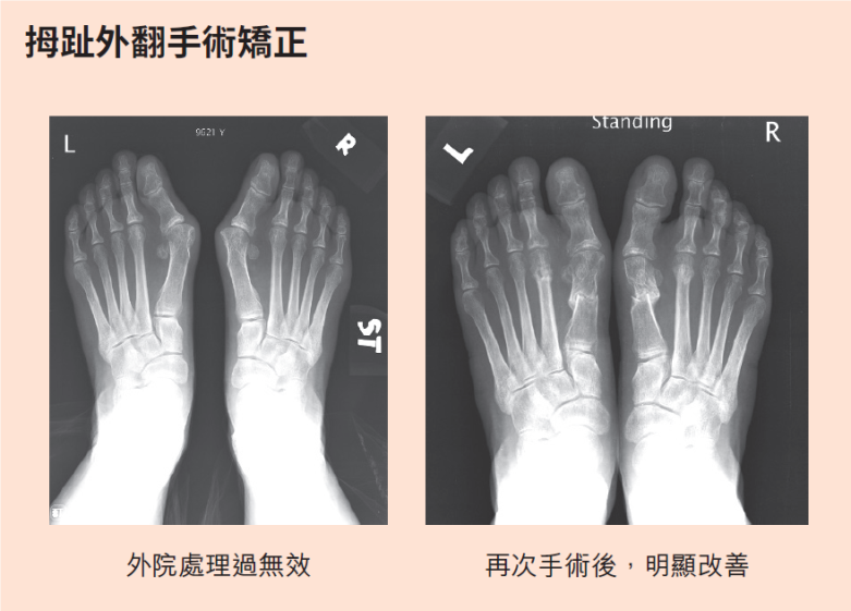 「拇趾外翻」動手術沒用!?名醫揭病症錯誤迷思：並非不治之症