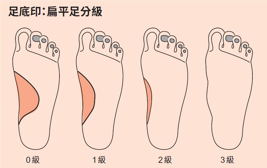 花了上萬元治不好？輕鬆根治「小兒扁平足」：請把握孩子關鍵年紀