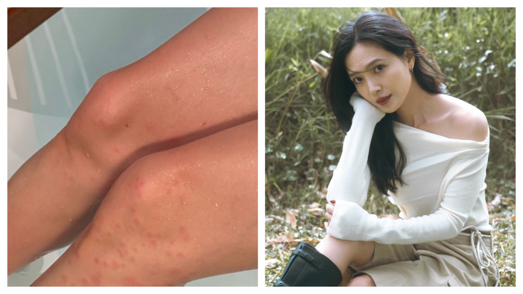 吳子霏森林裡拍網美照曝驚人慘狀　「露美腿」被小黑蚊叮爆