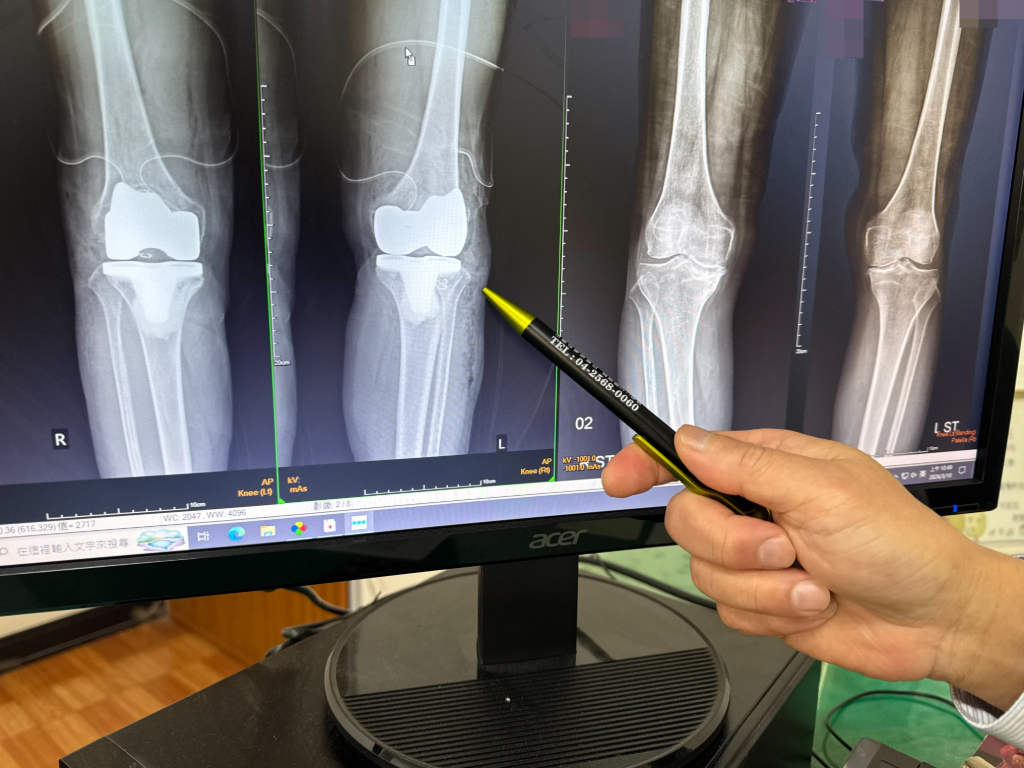 陳傑憲左手指骨裂引關注　醫示警：受傷硬撐恐釀關節退化