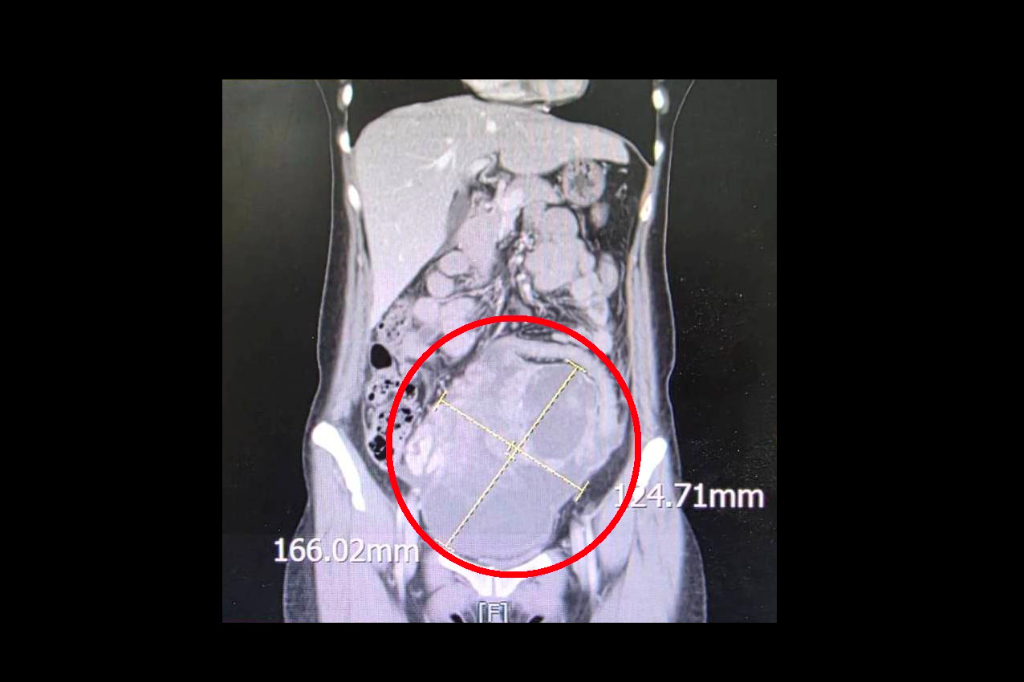 腹痛、食慾不振以為腸胃炎！44歲女「16公分腫瘤」切除　醫：確診「同步雙癌」