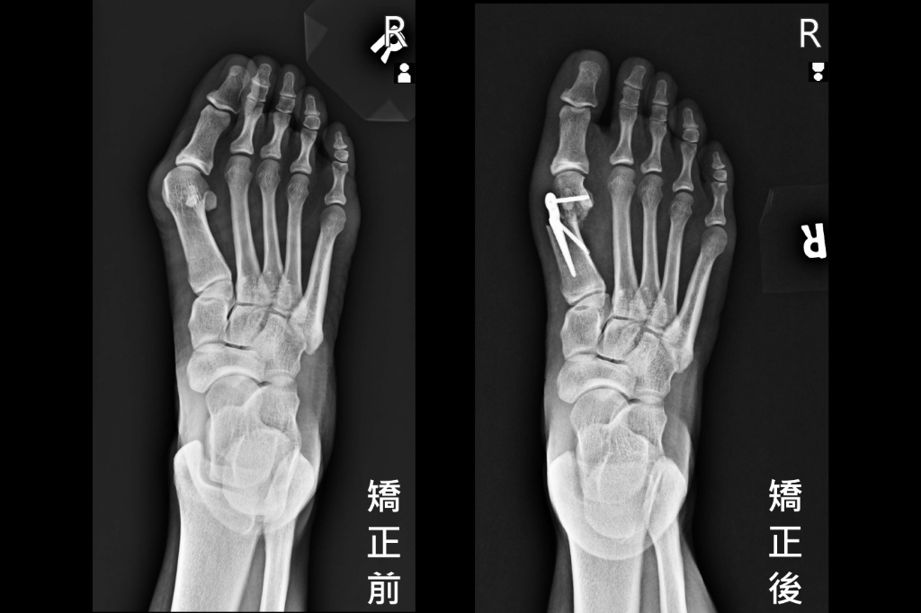 走路痛？小心「拇趾外翻」悄搶生活品質　醫示警：三徵兆應儘早就醫